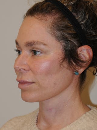 Facelift Before & After Gallery - Patient 370691 - Image 8