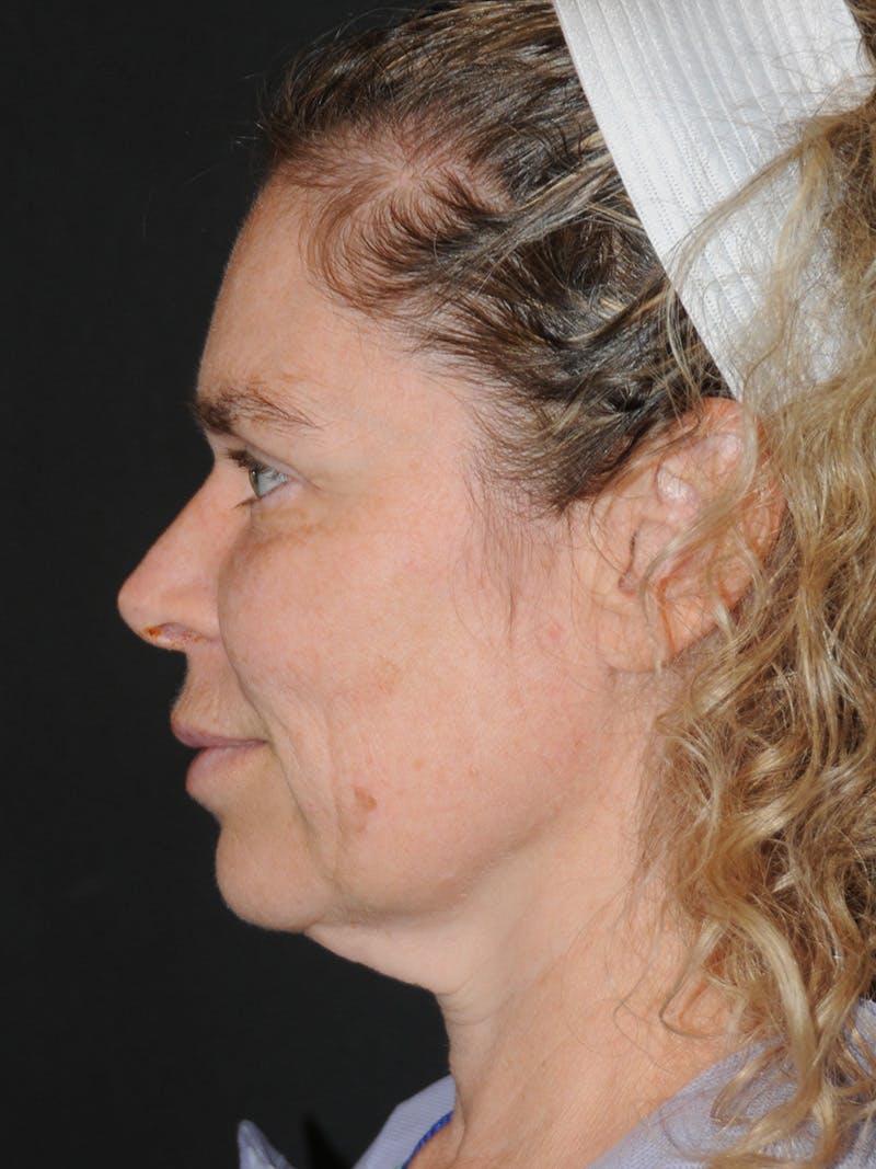 Facelift Before & After Gallery - Patient 370691 - Image 9