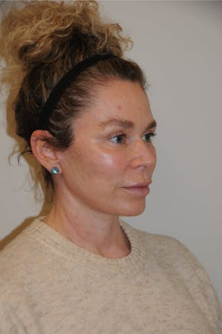 Brow Lift Before & After Gallery - Patient 263870 - Image 8