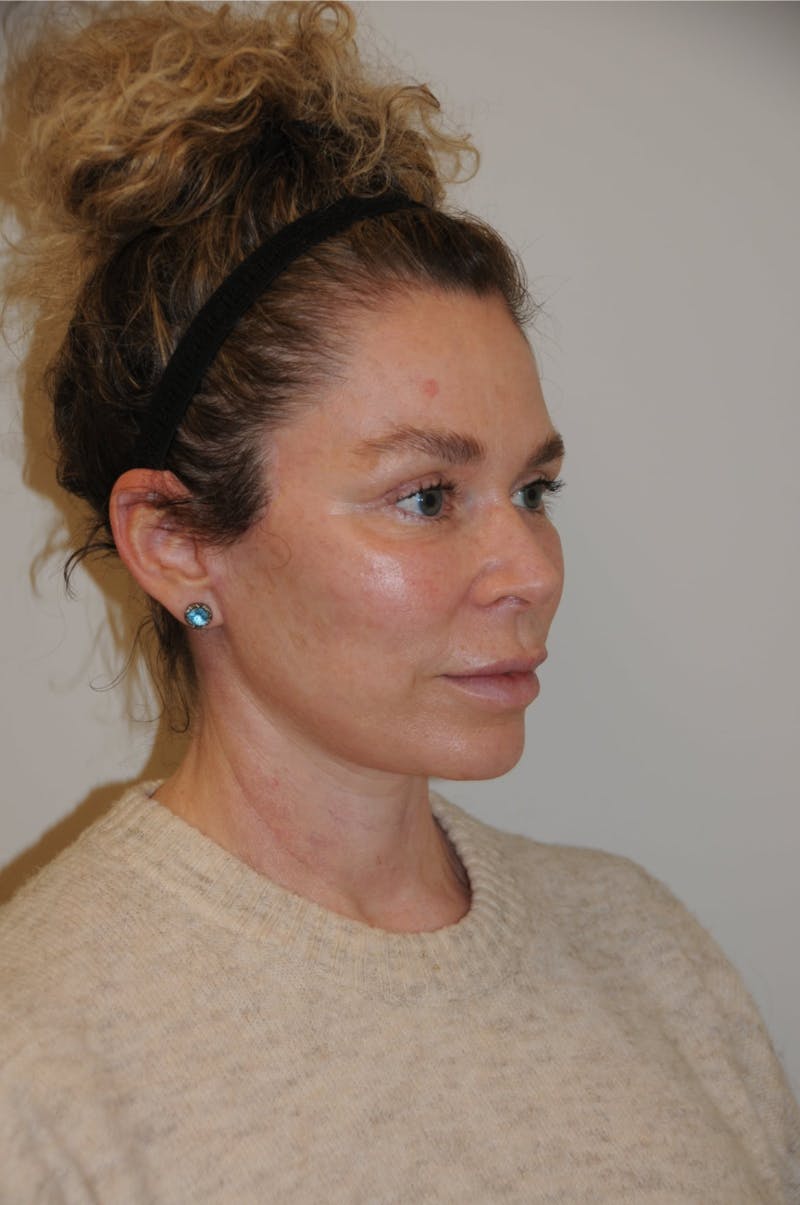 Brow Lift Before & After Gallery - Patient 263870 - Image 8