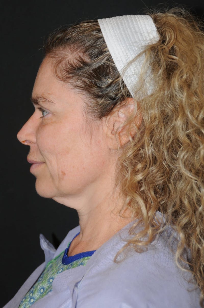 Brow Lift Before & After Gallery - Patient 263870 - Image 9