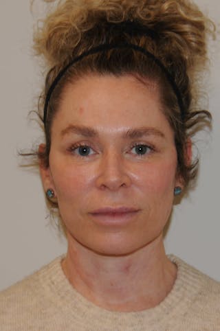Brow Lift Before & After Gallery - Patient 263870 - Image 2