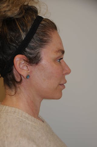 Brow Lift Before & After Gallery - Patient 263870 - Image 4