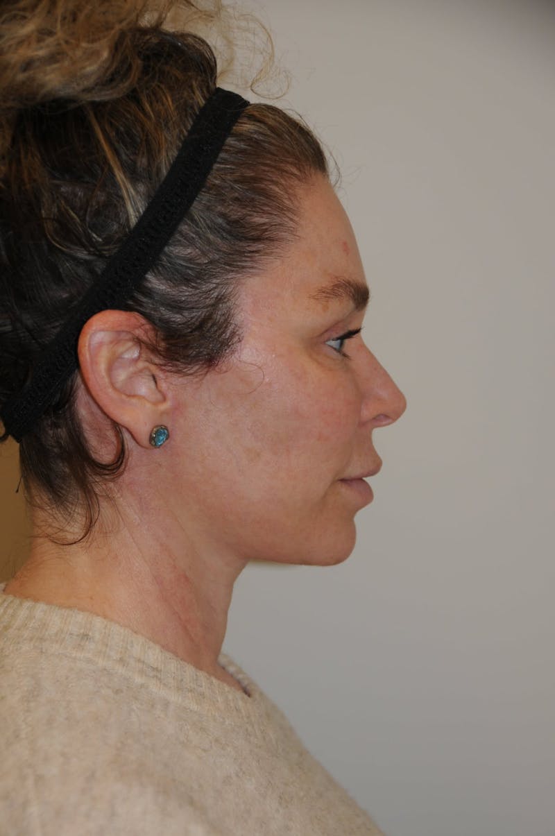 Brow Lift Before & After Gallery - Patient 263870 - Image 4