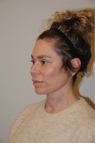 Brow Lift Before & After Gallery - Patient 263870 - Image 6