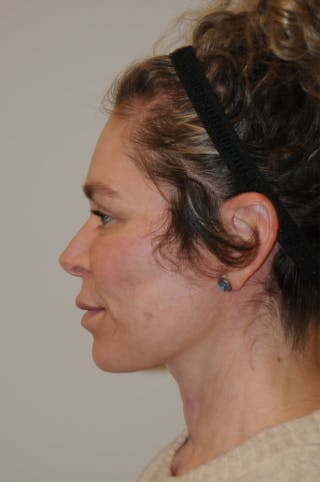 Brow Lift Before & After Gallery - Patient 263870 - Image 10