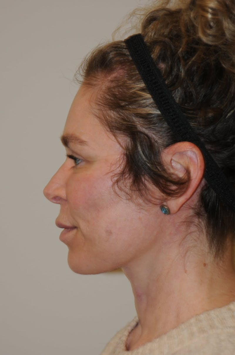 Brow Lift Before & After Gallery - Patient 263870 - Image 10