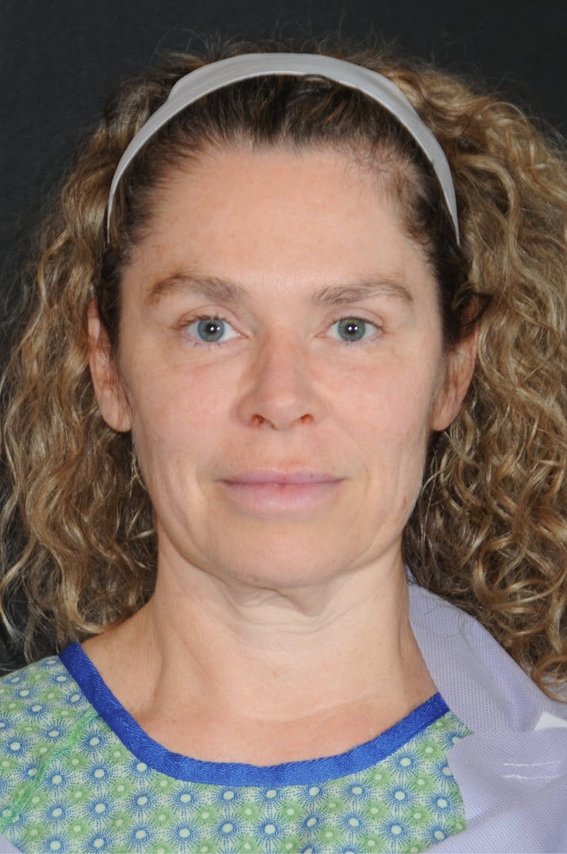 Brow Lift Before & After Gallery - Patient 263870 - Image 1