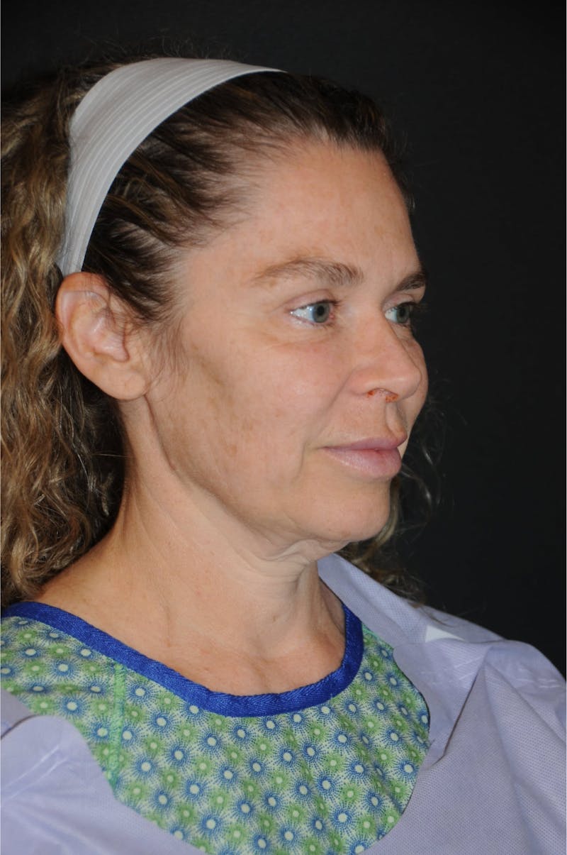 Brow Lift Before & After Gallery - Patient 263870 - Image 7