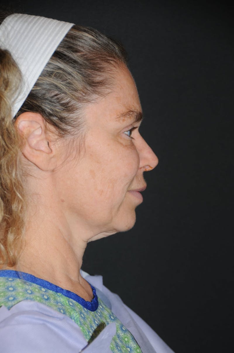 Brow Lift Before & After Gallery - Patient 263870 - Image 3