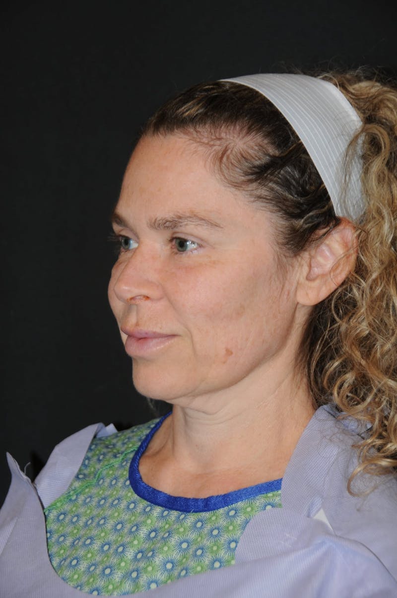 Brow Lift Before & After Gallery - Patient 263870 - Image 5