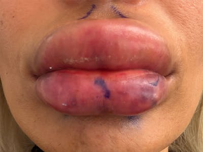 Fat Transfer Before & After Gallery - Patient 137880 - Image 1