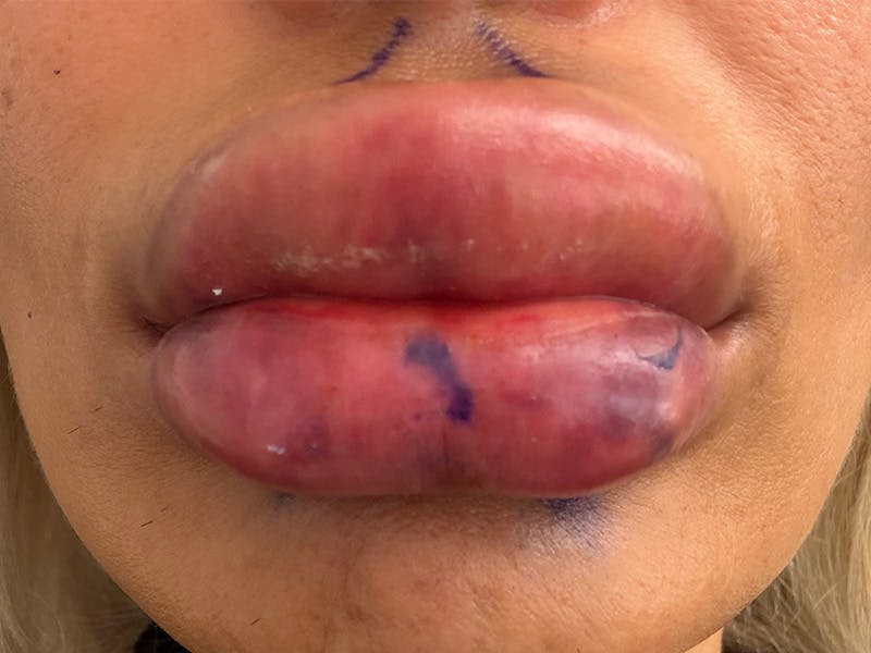 Fat Transfer Before & After Gallery - Patient 137880 - Image 1