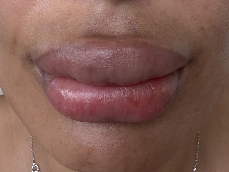 Fat Transfer Before & After Gallery - Patient 137880 - Image 3