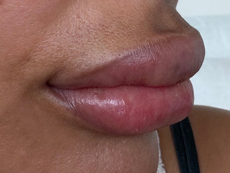 Fat Transfer Before & After Gallery - Patient 137880 - Image 7