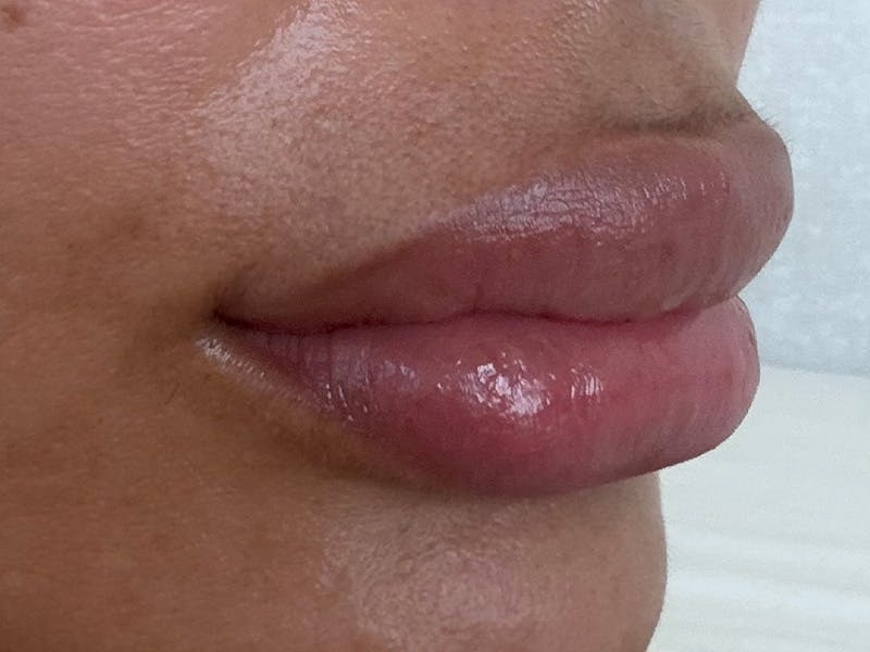 Fat Transfer Before & After Gallery - Patient 137880 - Image 8