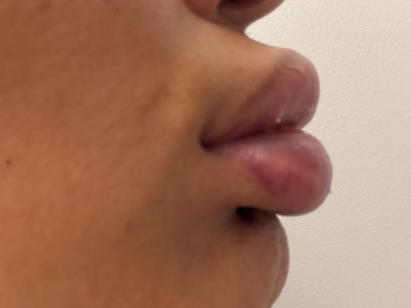 Fat Transfer Before & After Gallery - Patient 137880 - Image 9