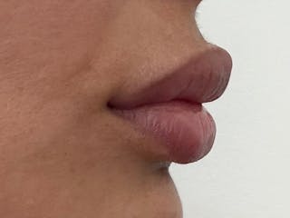 Fat Transfer Before & After Gallery - Patient 137880 - Image 10
