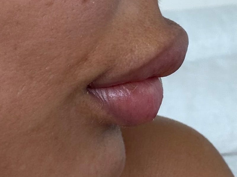 Fat Transfer Before & After Gallery - Patient 137880 - Image 11