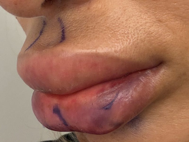 Fat Transfer Before & After Gallery - Patient 137880 - Image 13