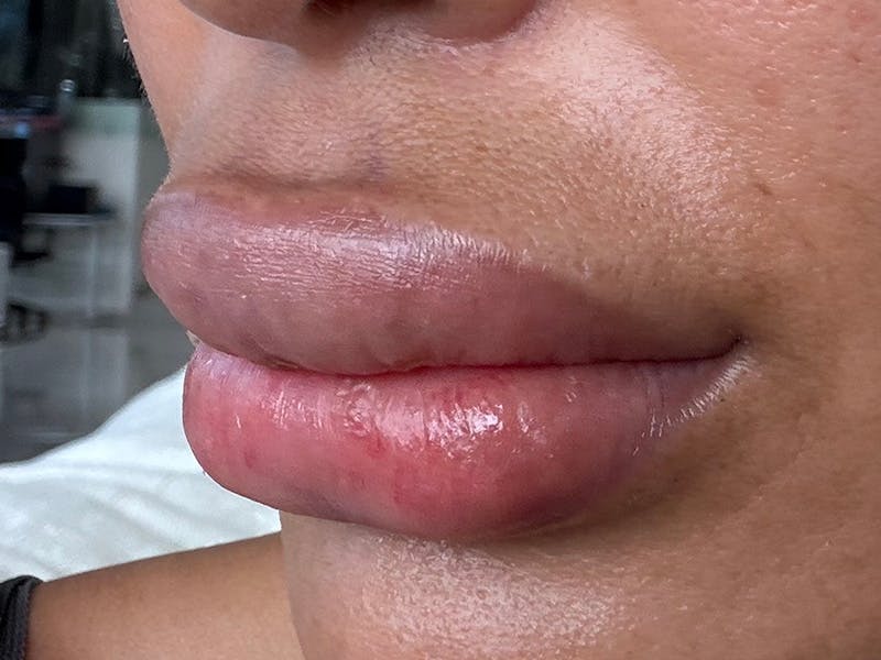 Fat Transfer Before & After Gallery - Patient 137880 - Image 15