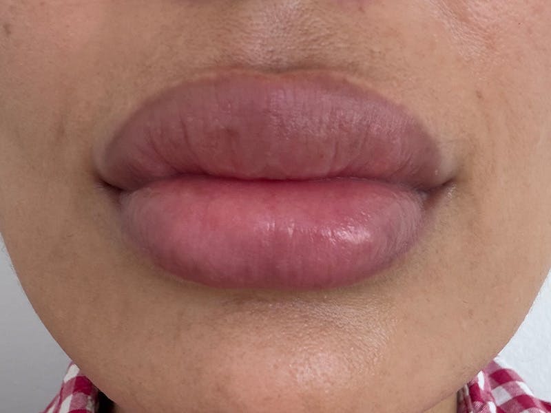 Fat Transfer Before & After Gallery - Patient 137880 - Image 2