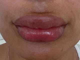 Fat Transfer Before & After Gallery - Patient 137880 - Image 4