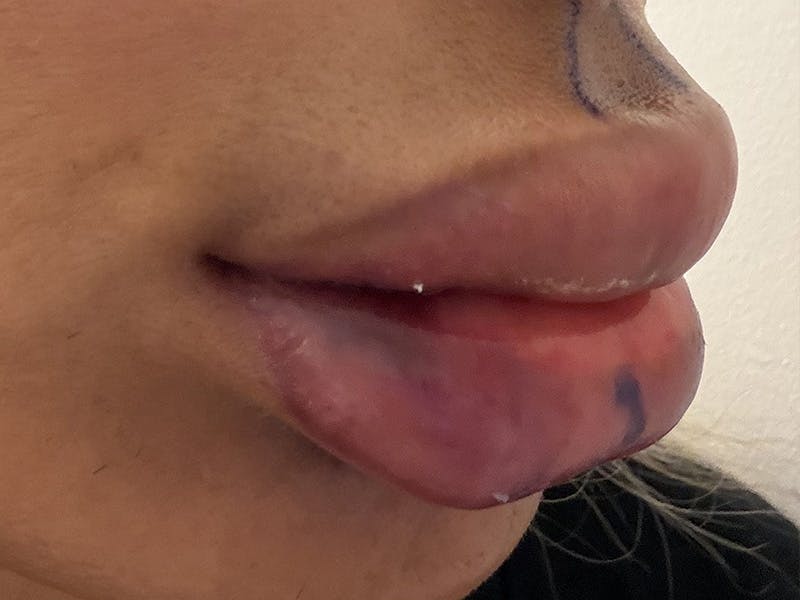 Fat Transfer Before & After Gallery - Patient 137880 - Image 5