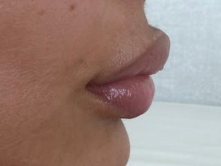 Fat Transfer Before & After Gallery - Patient 137880 - Image 12