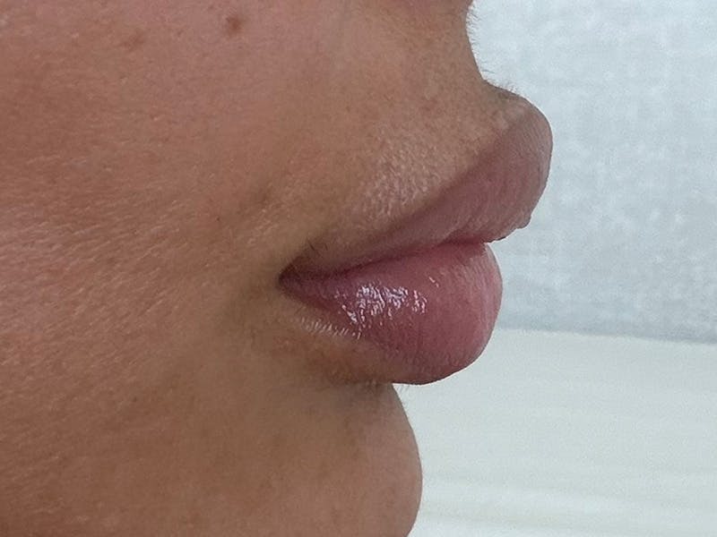 Fat Transfer Before & After Gallery - Patient 137880 - Image 12