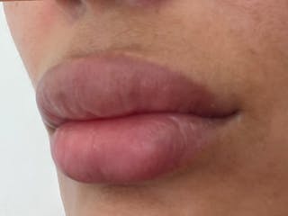 Fat Transfer Before & After Gallery - Patient 137880 - Image 14