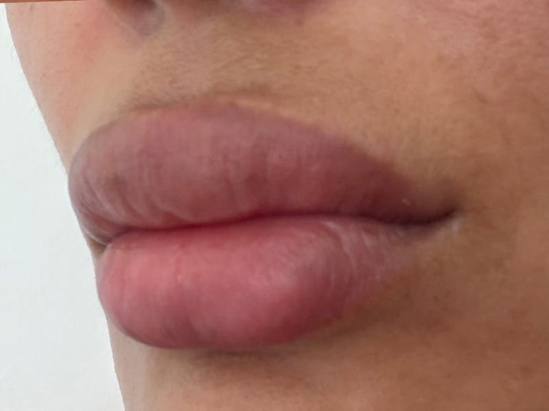 Fat Transfer Before & After Gallery - Patient 137880 - Image 14