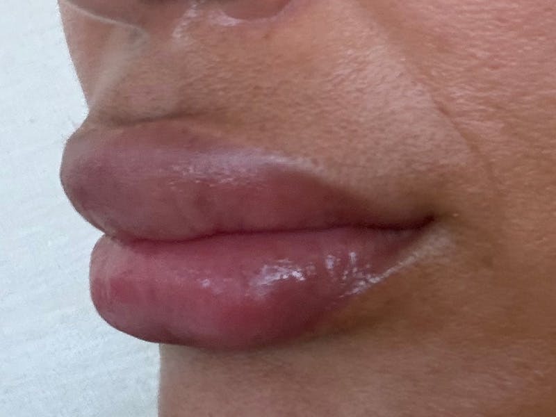 Fat Transfer Before & After Gallery - Patient 137880 - Image 16