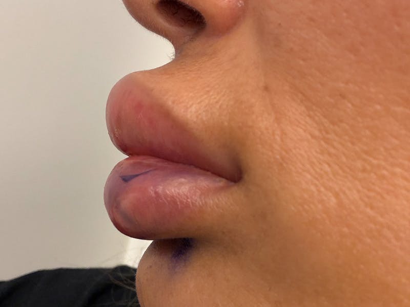 Fat Transfer Before & After Gallery - Patient 137880 - Image 17