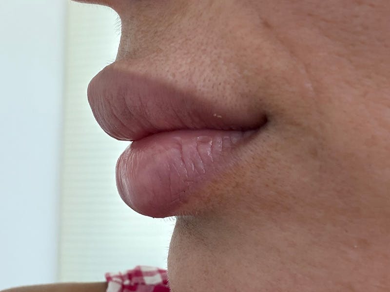 Fat Transfer Before & After Gallery - Patient 137880 - Image 18