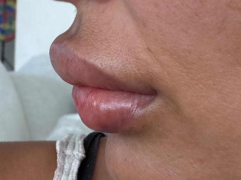Fat Transfer Before & After Gallery - Patient 137880 - Image 19