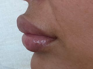 Fat Transfer Before & After Gallery - Patient 137880 - Image 20