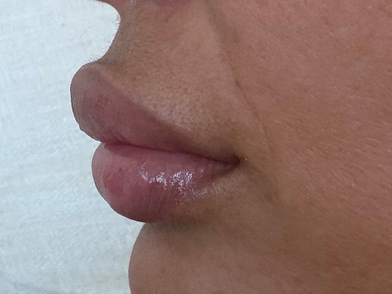 Fat Transfer Before & After Gallery - Patient 137880 - Image 20