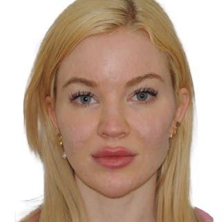 Acne Scar Treatment Before & After Gallery - Patient 255932 - Image 2