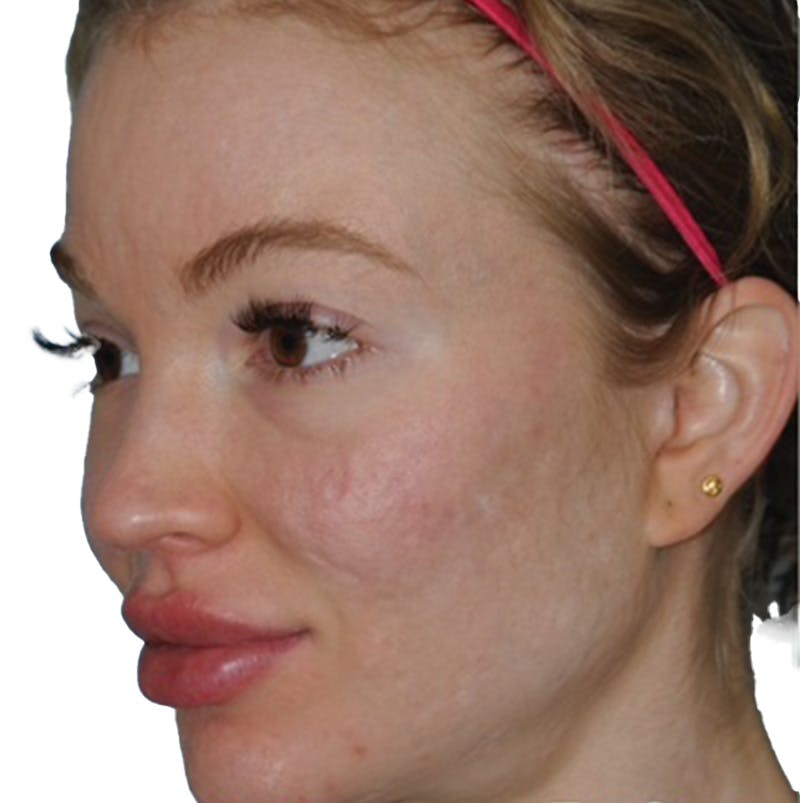 Acne Scar Treatment Before & After Gallery - Patient 255932 - Image 3