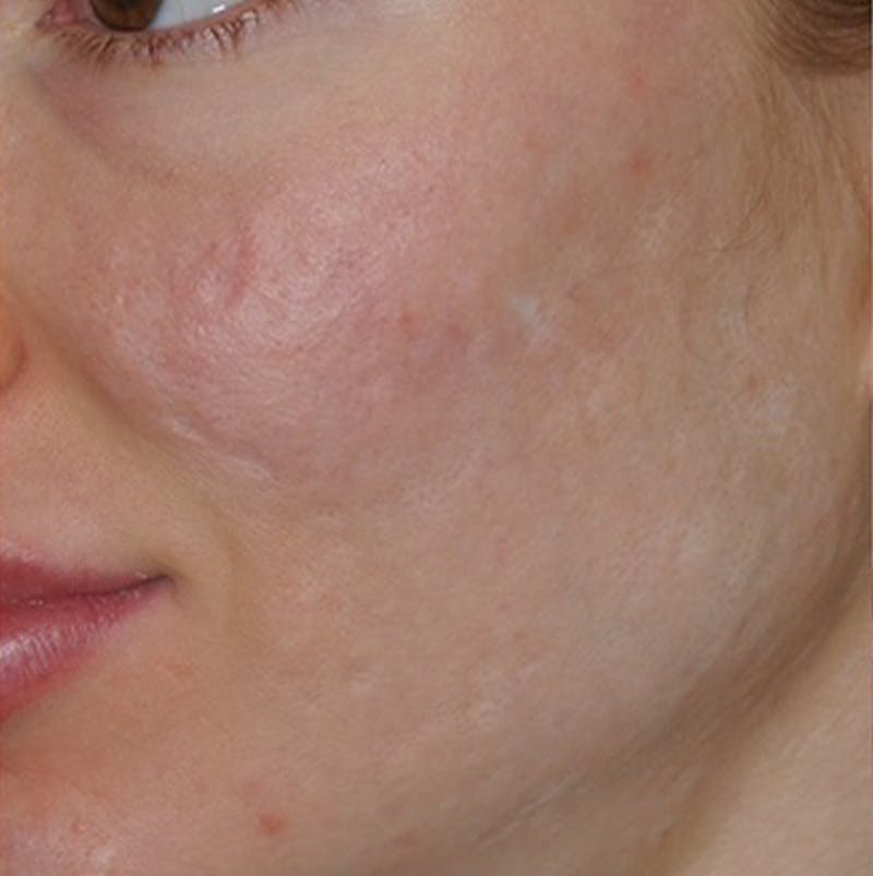 Acne Scar Treatment Before & After Gallery - Patient 255932 - Image 5
