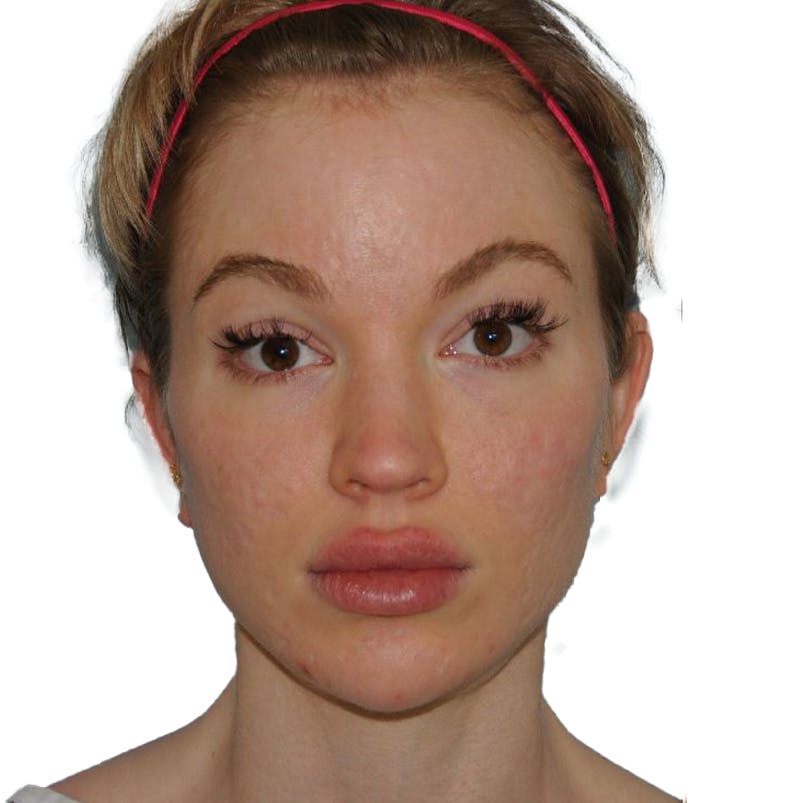 Acne Scar Treatment Before & After Gallery - Patient 255932 - Image 1