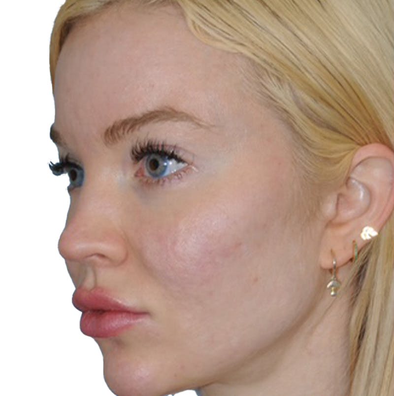 Acne Scar Treatment Before & After Gallery - Patient 255932 - Image 4
