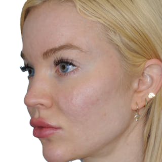 Acne Scar Treatment Before & After Gallery - Patient 255932 - Image 4