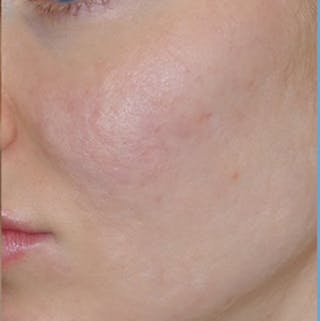Acne Scar Treatment Before & After Gallery - Patient 255932 - Image 6