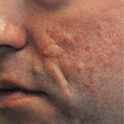 Acne Scar Treatment Before & After Gallery - Patient 120097 - Image 1