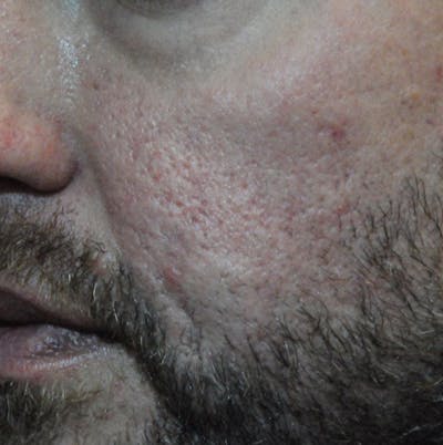 Acne Scar Treatment Before & After Gallery - Patient 120097 - Image 2