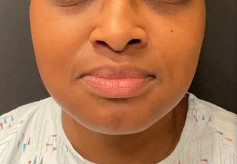 Buccal Fat Removal Before & After Gallery - Patient 378685 - Image 1