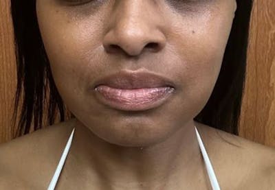 Buccal Fat Removal Before & After Gallery - Patient 378685 - Image 2