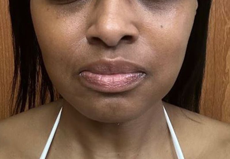 Buccal Fat Removal Before & After Gallery - Patient 378685 - Image 2